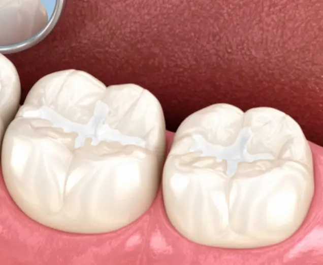 dental sealant
