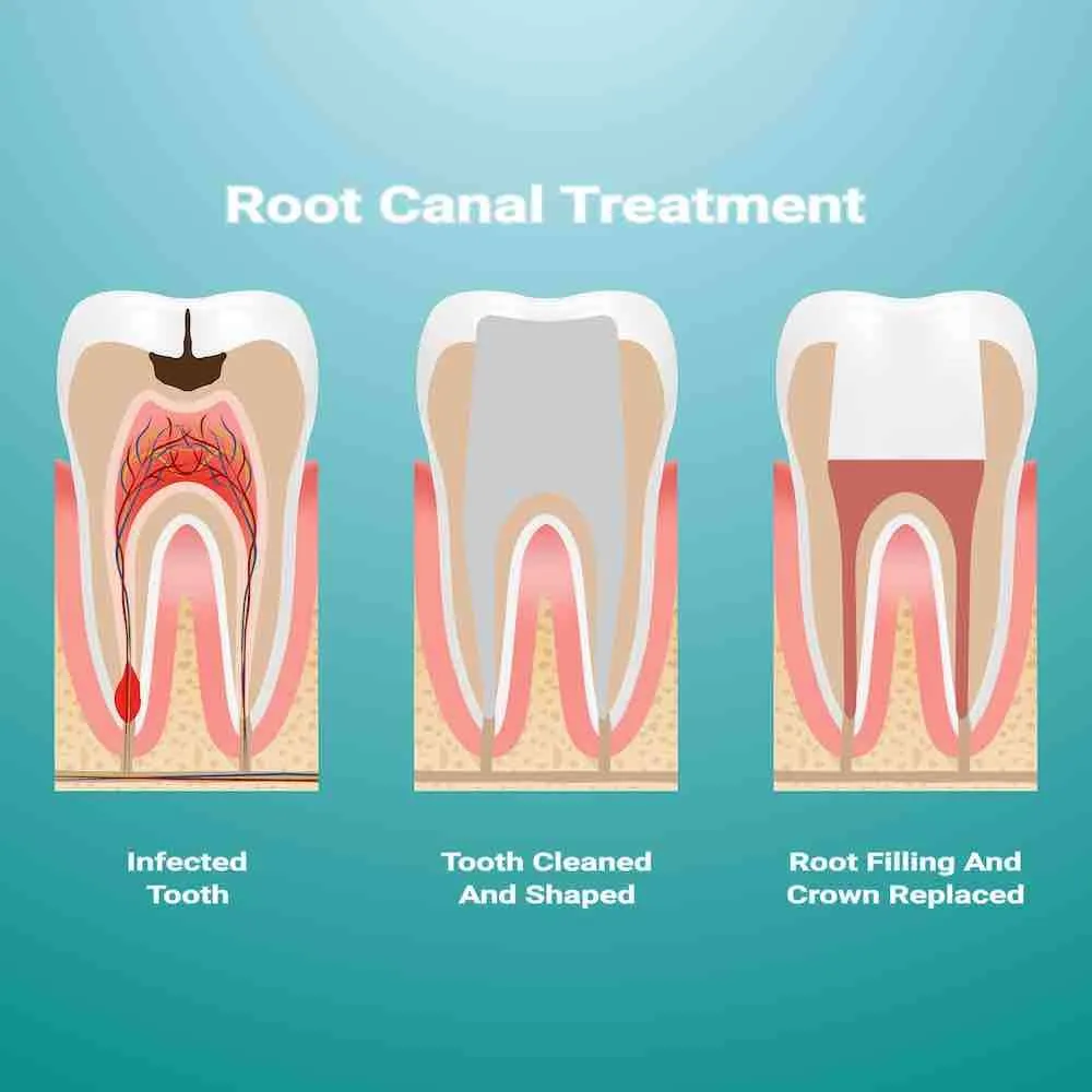 child root canal treatment
