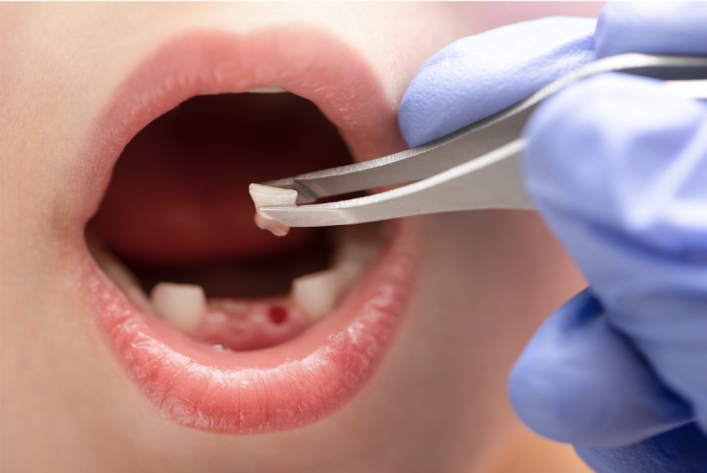 dental extraction kids